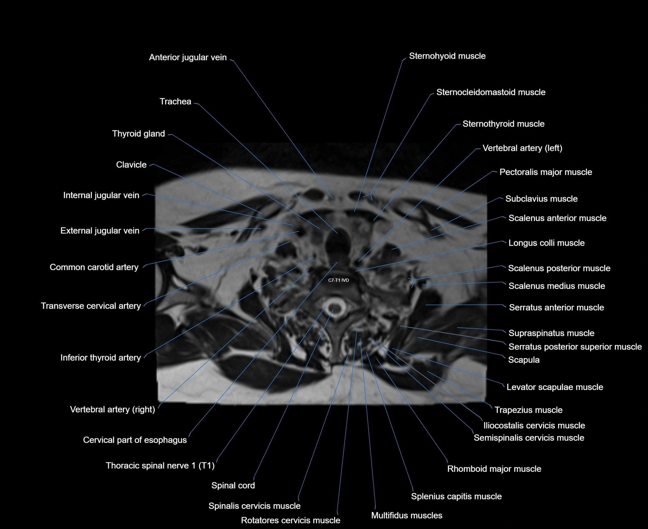 MRI Neck 3D labelled cross section anatomy axial 3t image-00001-00082.webp